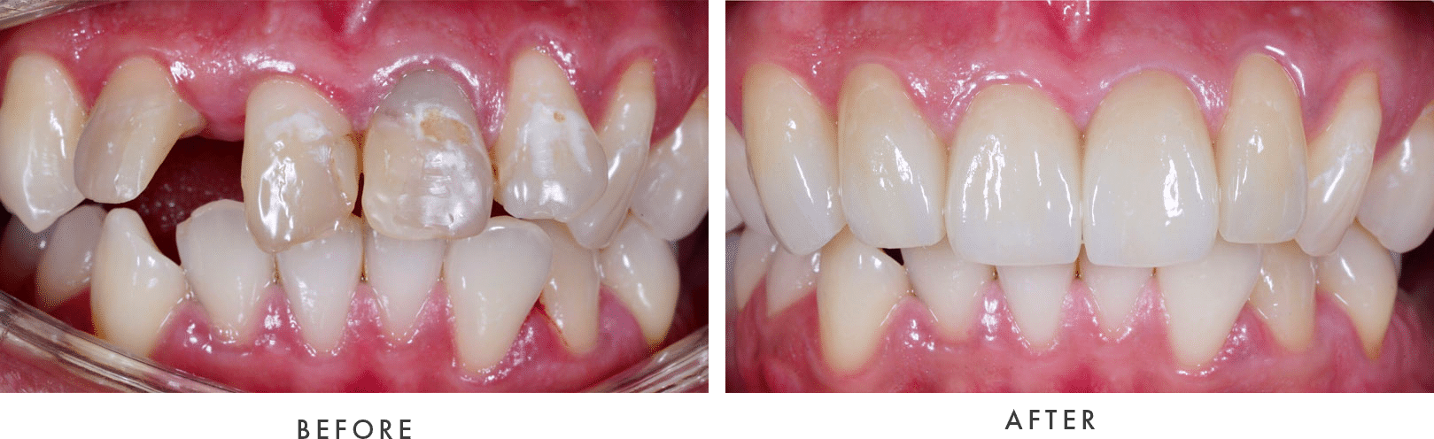 dental implant result