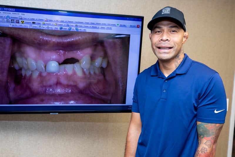 dental implant patient aliki smiling with before photos