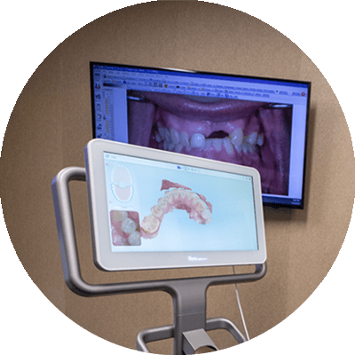 itero screen dental befores_for aliki a dental implant patient