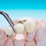 How to Care for Your Dental Bridge