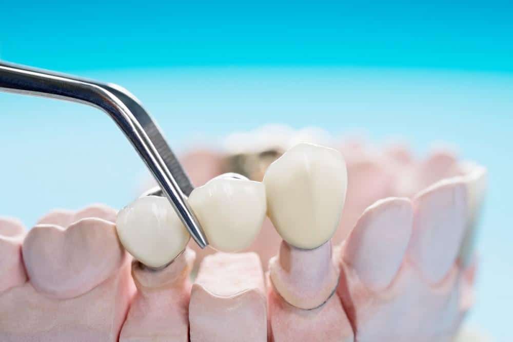 How to Care for Your Dental Bridge