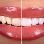 8 Ways to Manage Tooth Sensitivity After Whitening