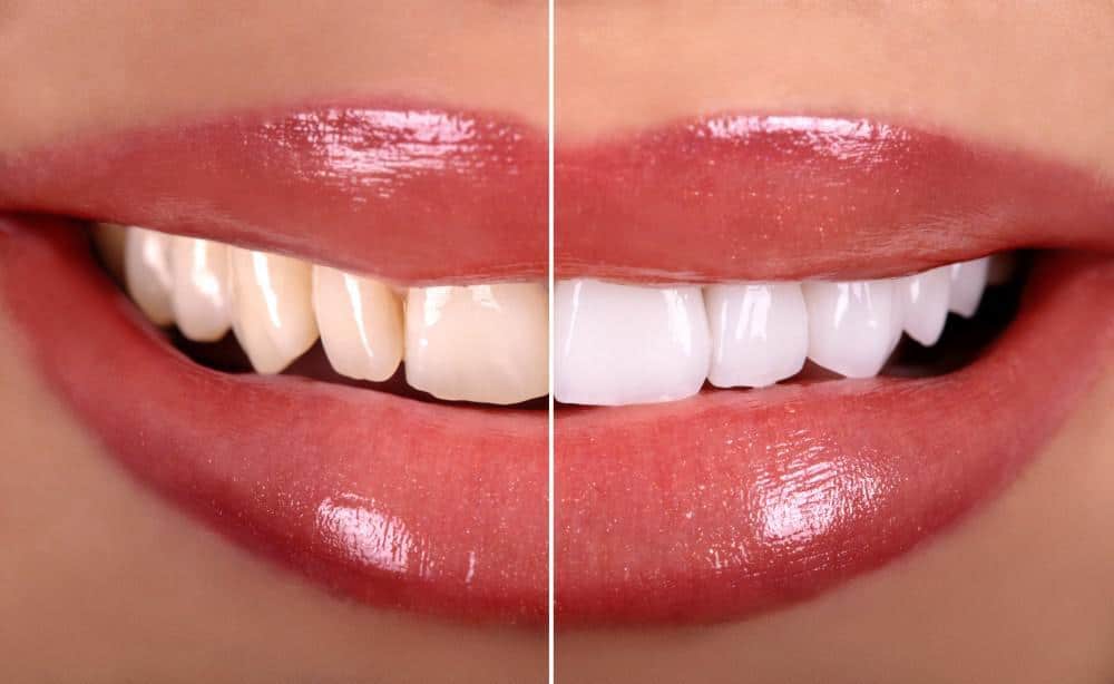 8 Ways to Manage Tooth Sensitivity After Whitening