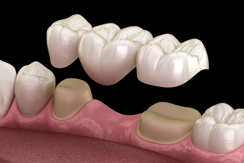 dental bridge model