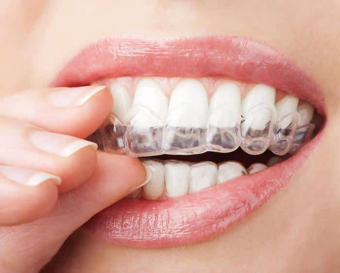 How Long Does Invisalign Take to Straighten Teeth?