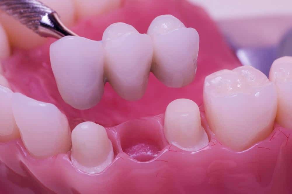 Not Your Grandparents’ Dentures — How Modern Dentures Enhance Your Smile