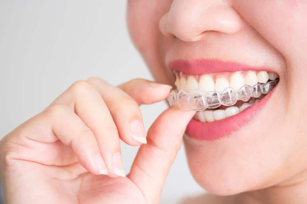 Tips for Making the Most of Invisalign®